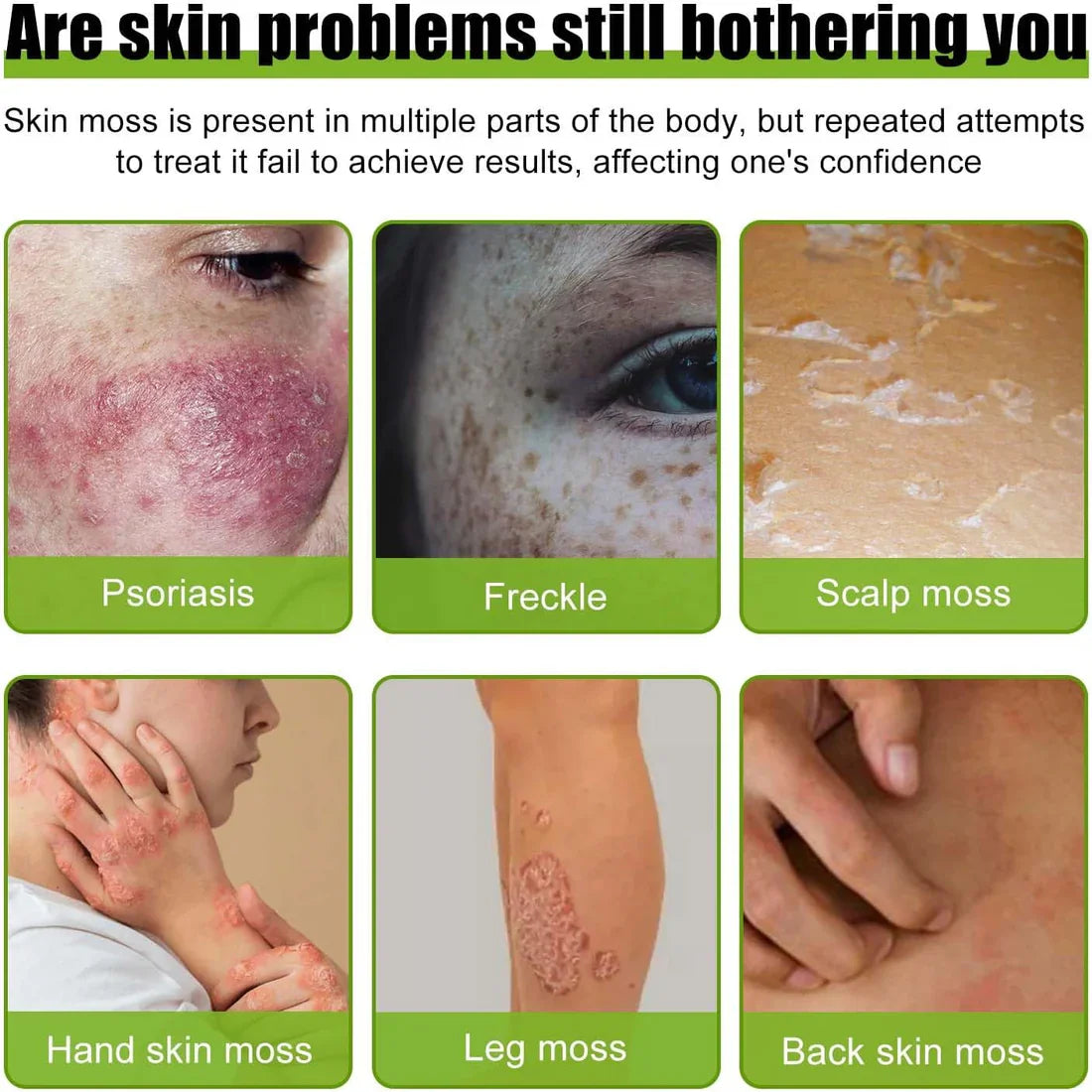 Todahof Bee Venom Psoriasis Treatment Cream, Todahof Bee Venom Psoriasis Treatment Cream, Todahof Bee Venom Cream, Psoriasis Cream, Bee Venom Psoriasis Treatment Cream (3 Pieces)