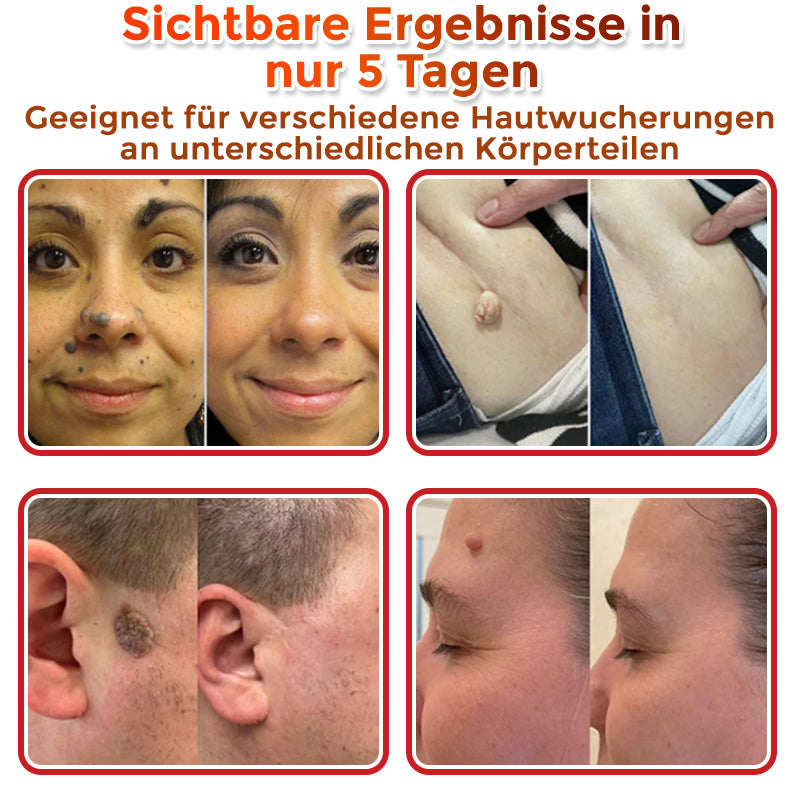 GFOUK® Microneedling Botanical Skin Tag Removal Patch 🇩🇪 Made in Germany