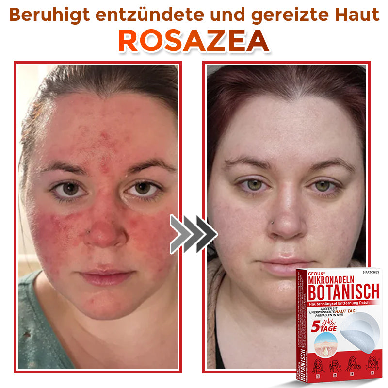 GFOUK® Microneedling Botanical Skin Tag Removal Patch 🇩🇪 Made in Germany
