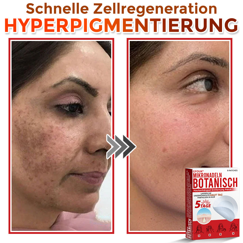GFOUK® Microneedling Botanical Skin Tag Removal Patch 🇩🇪 Made in Germany