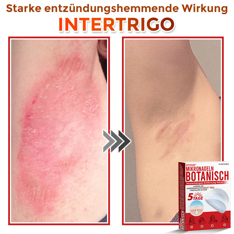 GFOUK® Microneedling Botanical Skin Tag Removal Patch 🇩🇪 Made in Germany