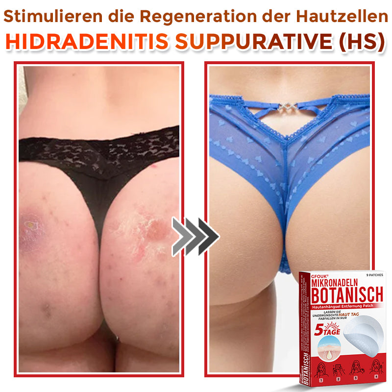 GFOUK® Microneedling Botanical Skin Tag Removal Patch 🇩🇪 Made in Germany