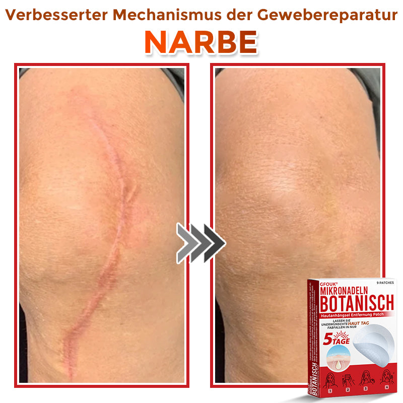 GFOUK® Microneedling Botanical Skin Tag Removal Patch 🇩🇪 Made in Germany