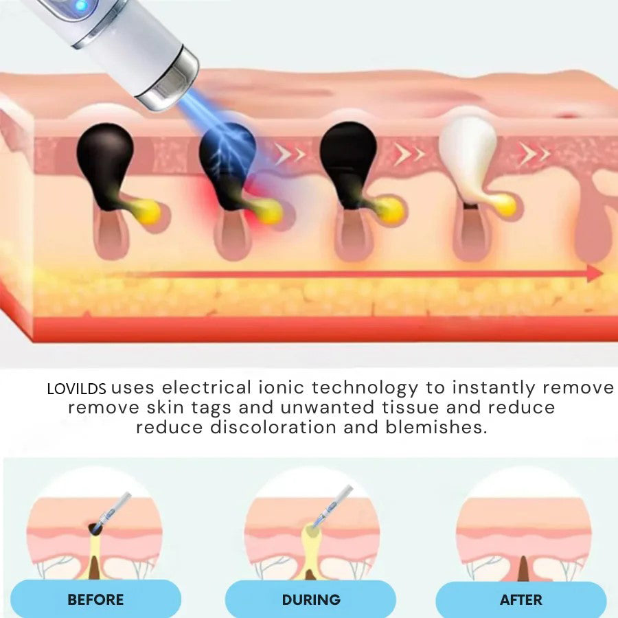 🔥【OFFICIAL STORE】Dougparmo™ Non-Invasive Mole and Wart Removal Laser Pen