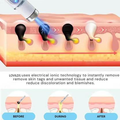 🔥【OFFICIAL STORE】Dougparmo™ Non-Invasive Mole and Wart Removal Laser Pen
