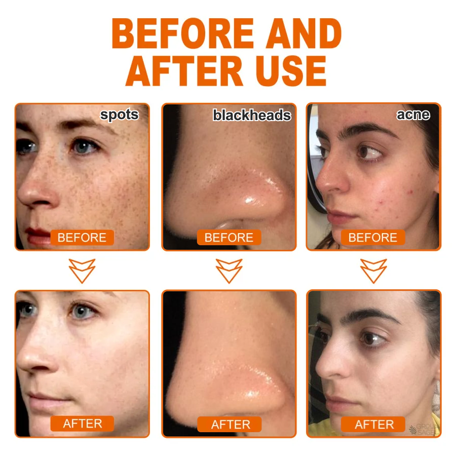 ✨Buy 2+ Get 2 Free✨Herbal Anti-Acne Peel-Off Mask