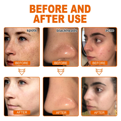 ✨Buy 2+ Get 2 Free✨Herbal Anti-Acne Peel-Off Mask