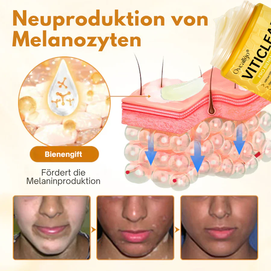 Oveallgo® VitiClear Pro Skin Care Cream – 90% effective relief from vitiligo