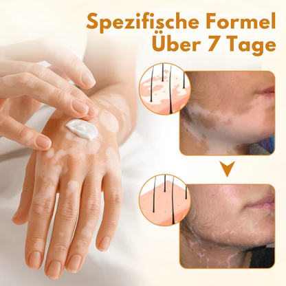 Fivfivgo® VitiCalm Bee Venom Cream, 95% Visible Improvement in 4 Weeks, Promotes Pigmentation &amp; Restores Natural Skin Tone