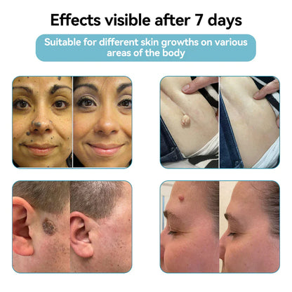 🇨🇦Bikenda® VelvetSkin+ All-in-One Laser Eraser Pen(Powered by CO₂ laser technology – effectively removes moles, warts, skin tags, pigmentation spots, and other skin imperfections)