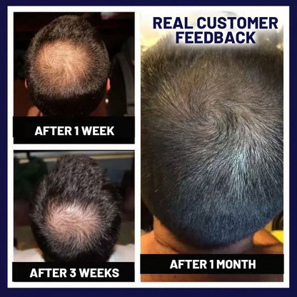 🌿LAST DAY OFFER – 50% OFF🌿 HZA™ Natural Hair Growth Spray 