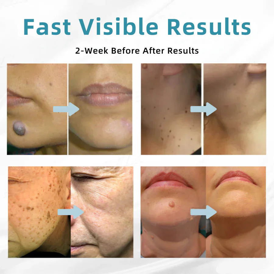 🇨🇦Bikenda® VelvetSkin+ All-in-One Laser Eraser Pen(Powered by CO₂ laser technology – effectively removes moles, warts, skin tags, pigmentation spots, and other skin imperfections)