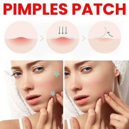 QUSTERE pimple patches for the face, hydrocolloid acne patches 