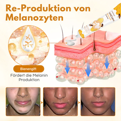 Fivfivgo® VitiCalm Bee Venom Cream, 95% Visible Improvement in 4 Weeks, Promotes Pigmentation &amp; Restores Natural Skin Tone