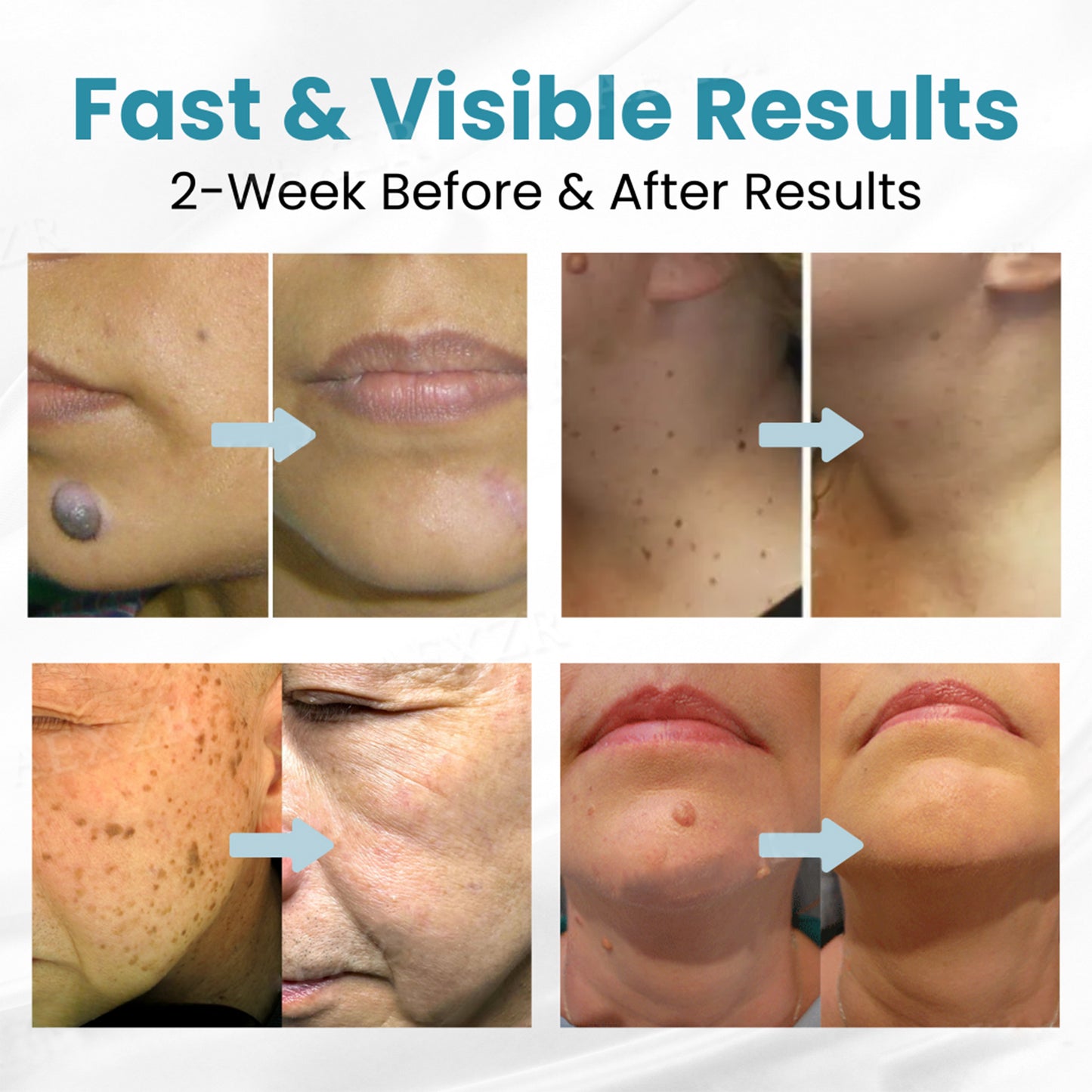 🔥【OFFICIAL STORE】Dougparmo™ Non-Invasive Mole and Wart Removal Laser Pen