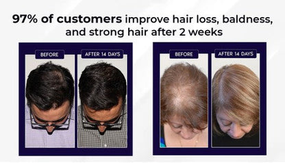 🌿LAST DAY OFFER – 50% OFF🌿 HZA™ Natural Hair Growth Spray 