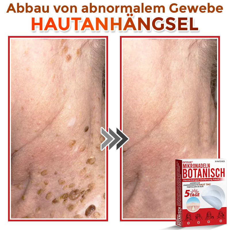 GFOUK® Microneedling Botanical Skin Tag Removal Patch 🇩🇪 Made in Germany