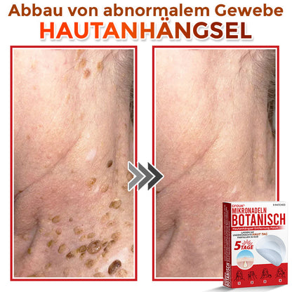 GFOUK® Microneedling Botanical Skin Tag Removal Patch 🇩🇪 Made in Germany