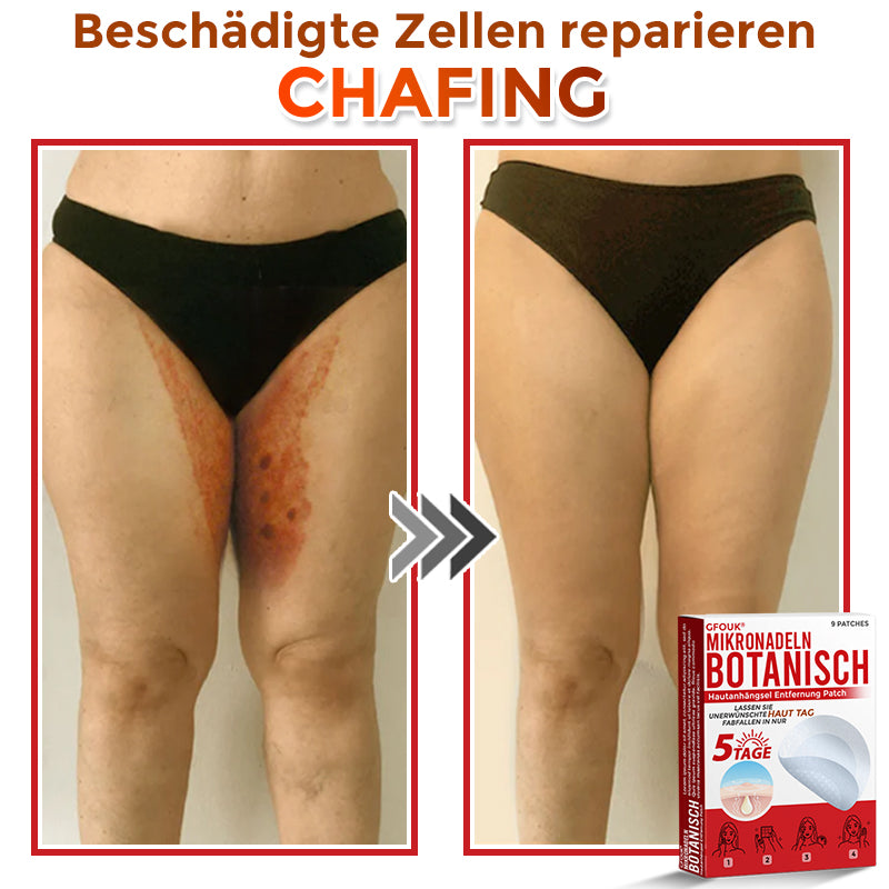 GFOUK® Microneedling Botanical Skin Tag Removal Patch 🇩🇪 Made in Germany