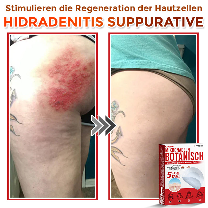 GFOUK® Microneedling Botanical Skin Tag Removal Patch 🇩🇪 Made in Germany