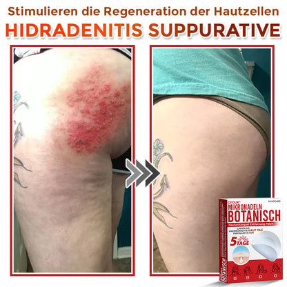 GFOUK® Microneedling Botanical Skin Tag Removal Patch 🇩🇪 Made in Germany
