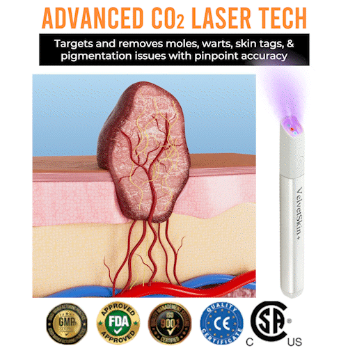 🛡️Dougparmo® VelvetSkin+ Integrated laser eraser ⚔︎(⚡powered by CO₂ laser technology - effectively removes moles, warts, skin labels, pigmentation spots and other skin defects)