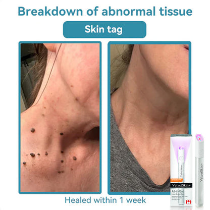 🇨🇦Bikenda® VelvetSkin+ All-in-One Laser Eraser Pen(Powered by CO₂ laser technology – effectively removes moles, warts, skin tags, pigmentation spots, and other skin imperfections)
