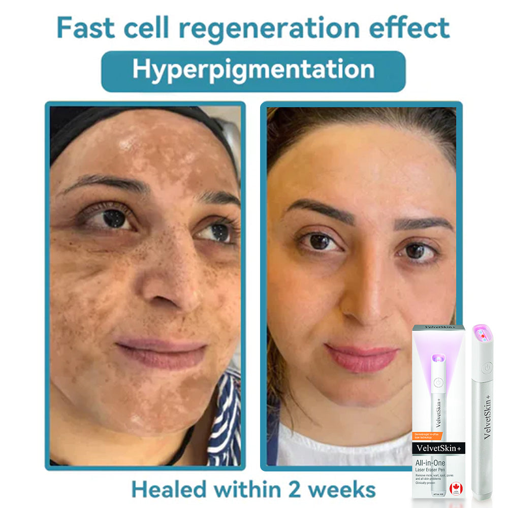 🇨🇦Bikenda® VelvetSkin+ All-in-One Laser Eraser Pen(Powered by CO₂ laser technology – effectively removes moles, warts, skin tags, pigmentation spots, and other skin imperfections)