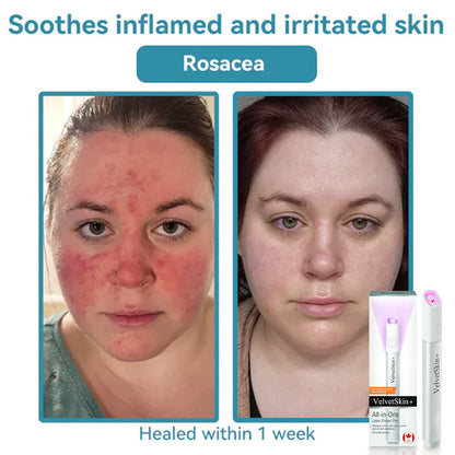 🇨🇦Bikenda® VelvetSkin+ All-in-One Laser Eraser Pen(Powered by CO₂ laser technology – effectively removes moles, warts, skin tags, pigmentation spots, and other skin imperfections)