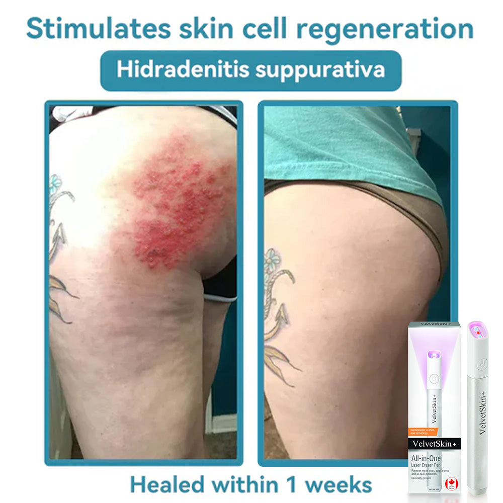 🇨🇦Bikenda® VelvetSkin+ All-in-One Laser Eraser Pen(Powered by CO₂ laser technology – effectively removes moles, warts, skin tags, pigmentation spots, and other skin imperfections)
