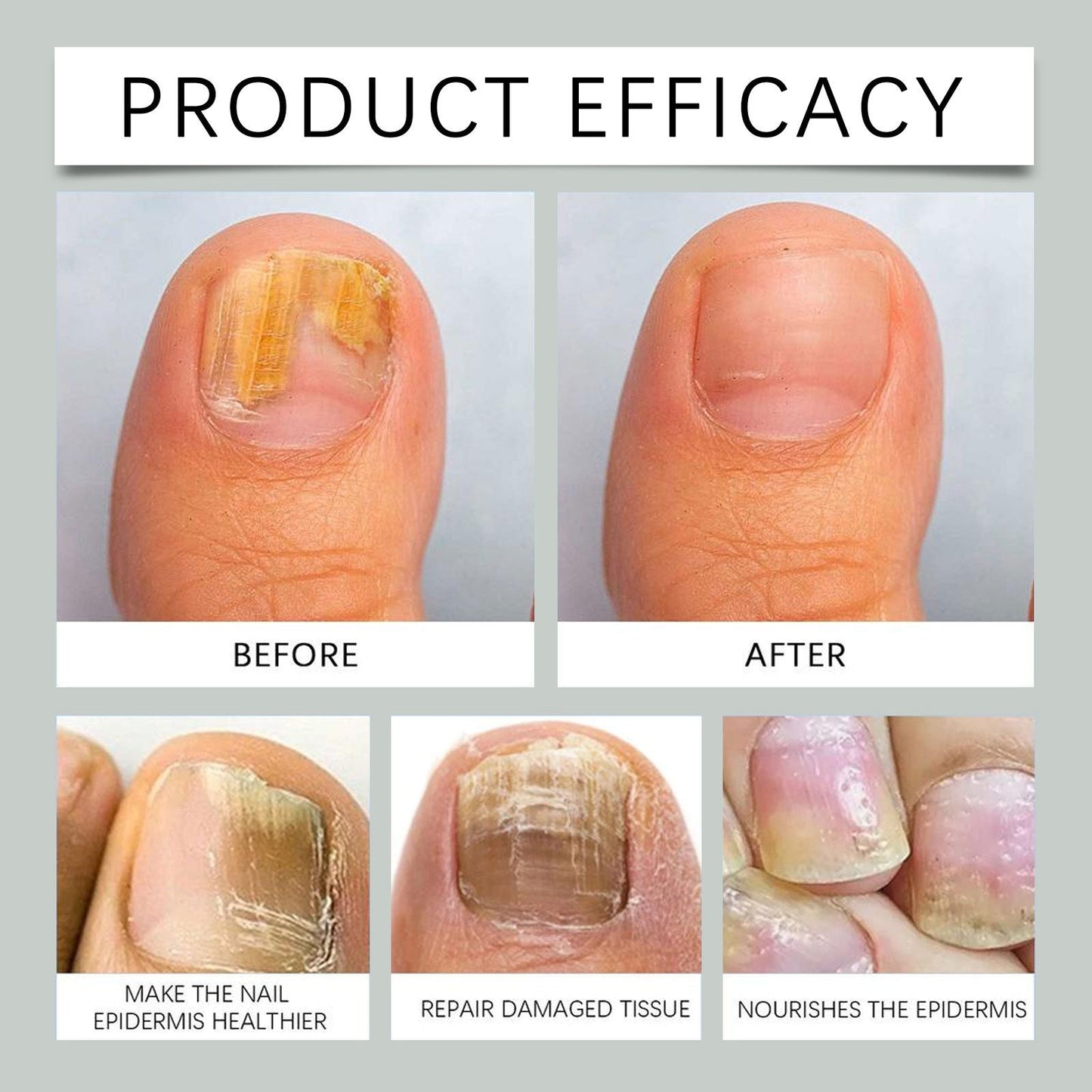 Furzero™ - SOUTH MOON🌟 Bee Venom Nail Fungus Treatment: A Complete Solution for Nail Fungus