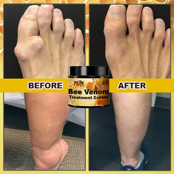 Bee venom cream for the treatment of arthritis