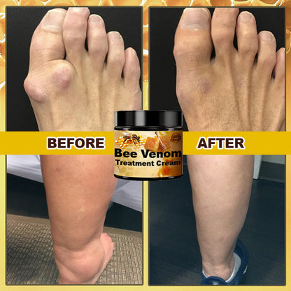 Bee venom cream for the treatment of arthritis